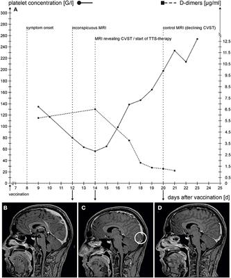 Case Report: Take a Second Look: Covid-19 Vaccination-Related Cerebral Venous Thrombosis and Thrombotic Thrombocytopenia Syndrome